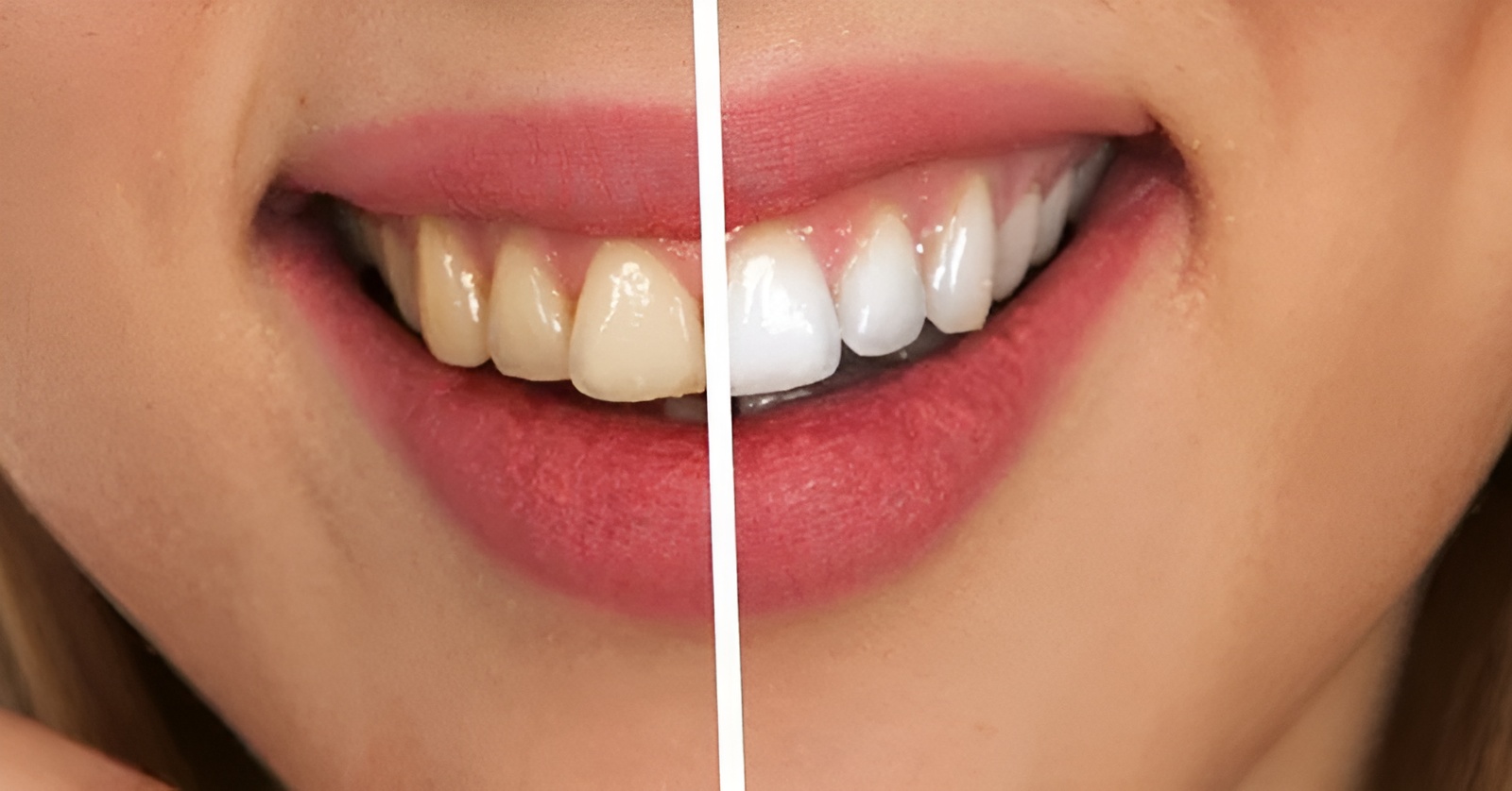 Single Tooth Implant